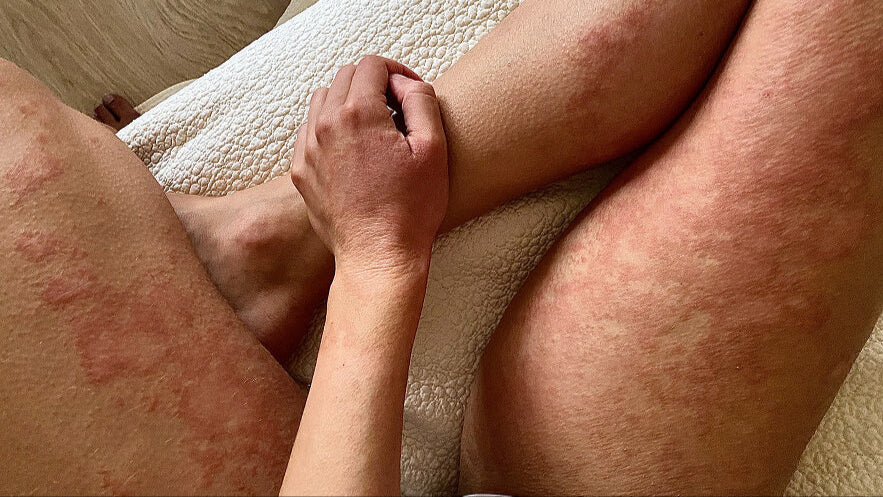 Eczéma Sévère et Vêtements : Les 5 Erreurs à Éviter (et Comment Deuxième Peau® Peut Vous Aider)