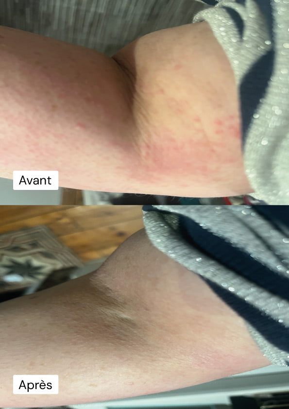 Photo avant et après fanny utilisation d’une manchette bras deuxième peau®, montrant une diminution des rougeurs et une peau visiblement apaisé