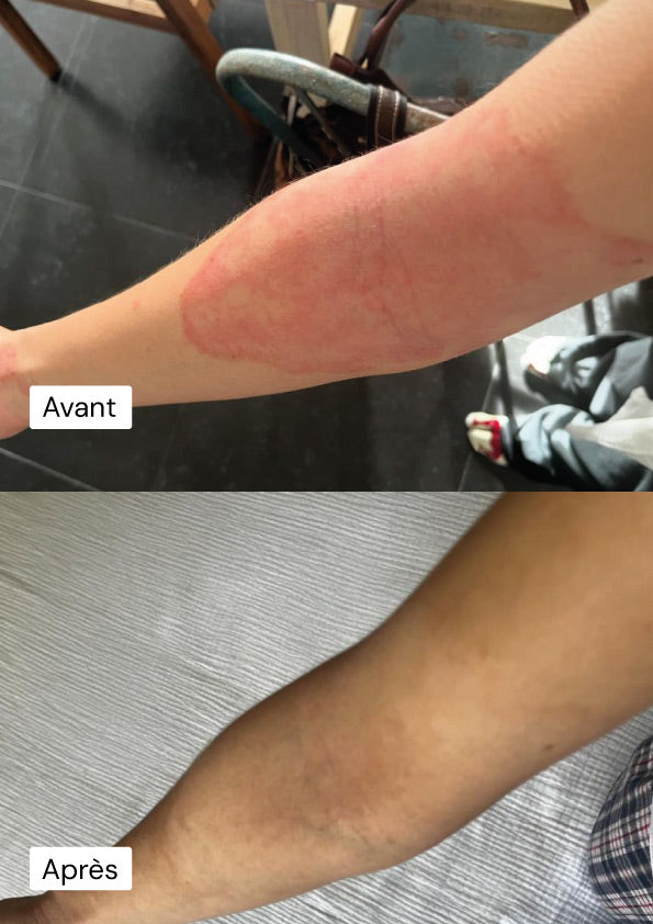 Photo avant et après de colette utilisation d’une manchette bras deuxième peau®, montrant une amélioration visible de l’eczéma et des rougeurs cutanées.