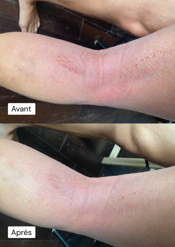 Photo avant et après de barbara utilisation d’un tube jambe deuxième peau®, montrant une amélioration visible de l’eczéma et un apaisement des rougeurs cutanées.